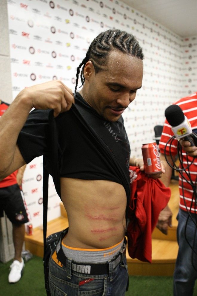 Meia Claiton, do Atlético, mostra as marcas da violência dos jogadores gremistas |