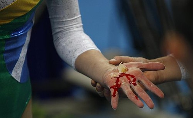 O esforço gera machucado na mão da ginasta Ana Silva |