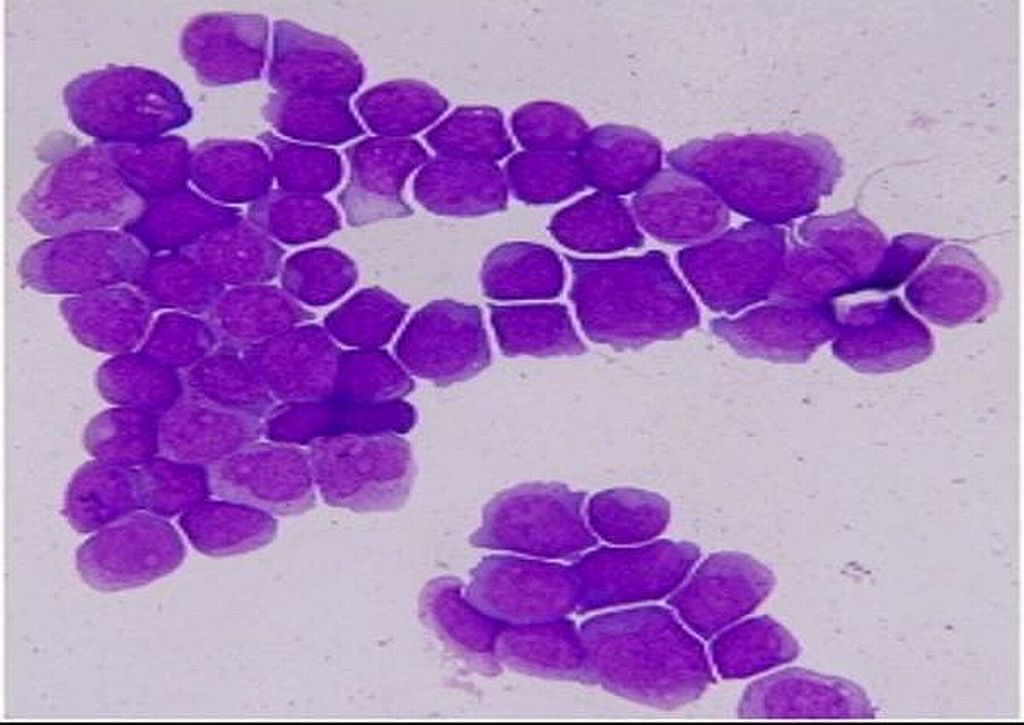 Células de paciente com leucemia mielóide aguda que tiveram seu DNA seqüenciado | Reprodução / Nature
