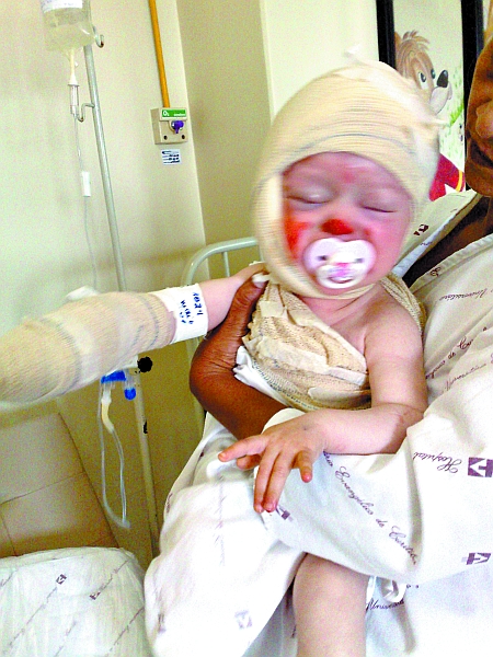 Lorena teve 18% do corpo queimado. | João Varella/Gazeta do Povo Oline