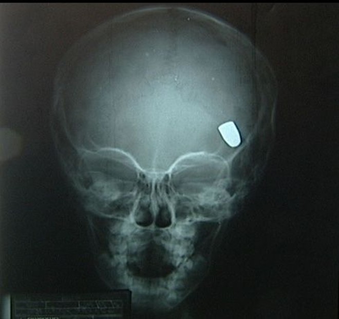Bala atravessou o cérebro e ficou alojada dentro da cabeça da criança |