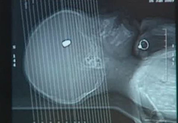 Criança foi operada e já deixou a UTI do hospital |