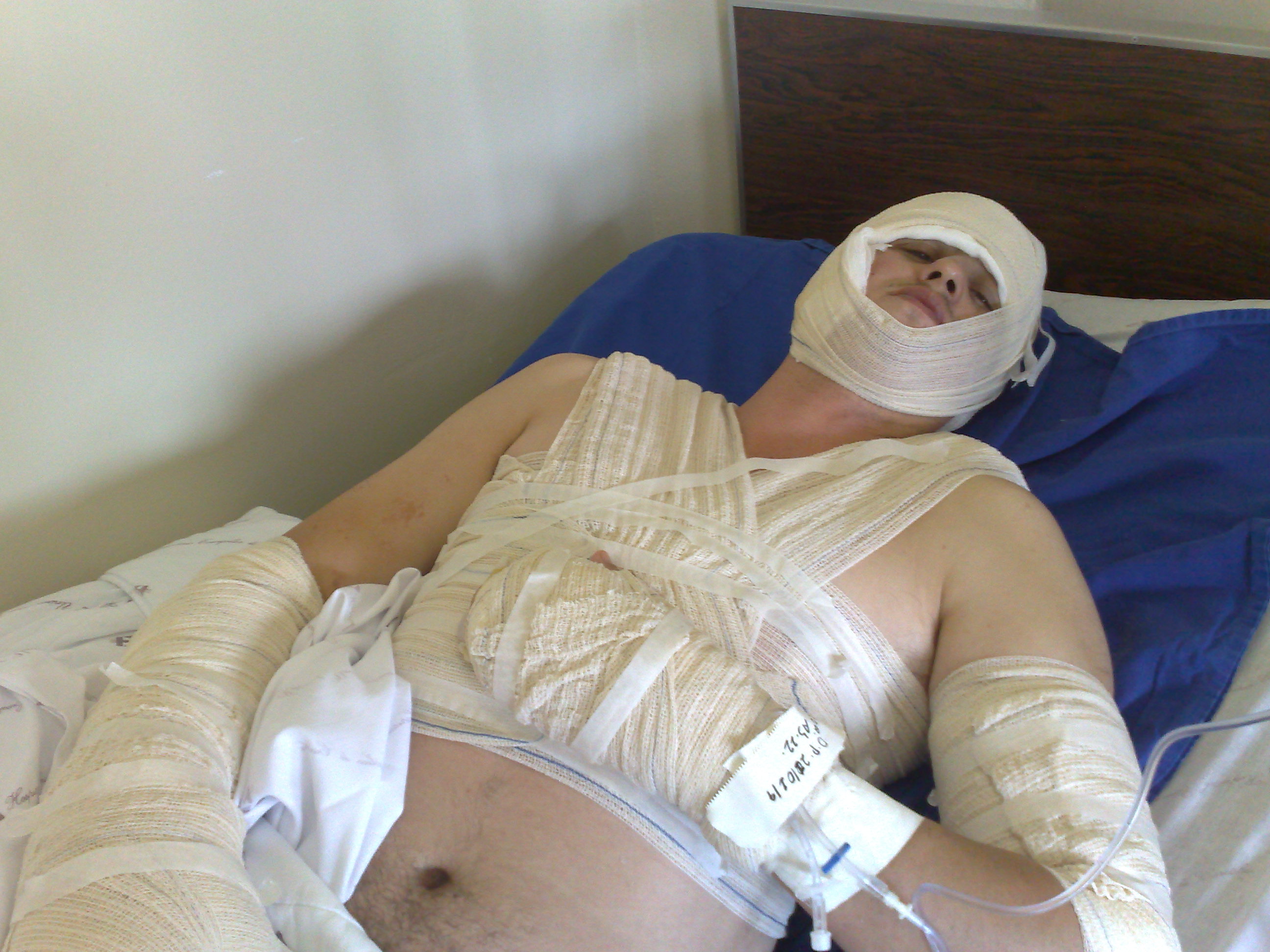 Luiz Renato Sodré, 26 anos, teve 15% do corpo queimado por um molotov na terça | João Varella / Gazeta do Povo