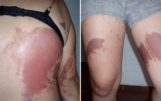 Queimaduras da estudante foram provocadas por mistura de gasolina e creolina | Arquivo pessoal