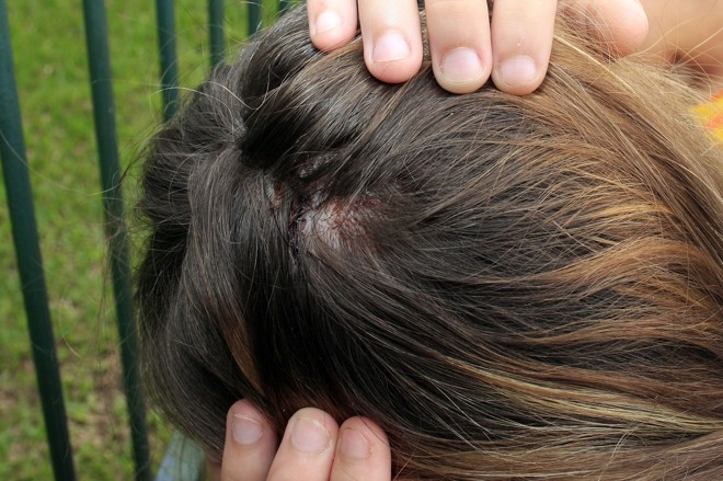 Adolescente de 16 anos teve de levar cinco pontos na cabeça | 