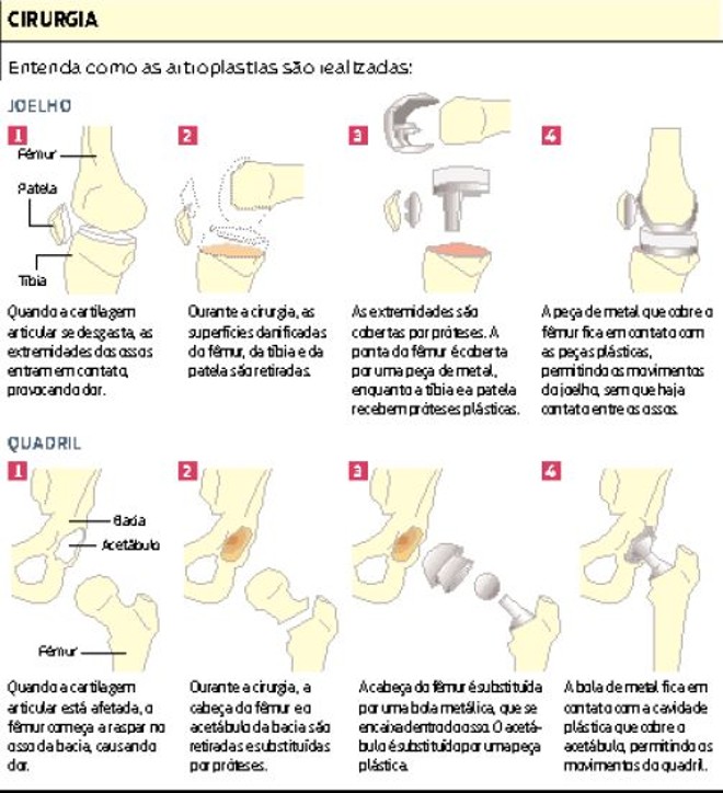Entenda como as artroplastias são realizadas | 