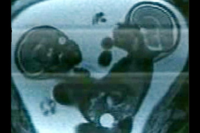 Ressonância magnética mostra que siameses estão unidos pelo tórax, abdome e bacia | Reprodução/TV Bahia