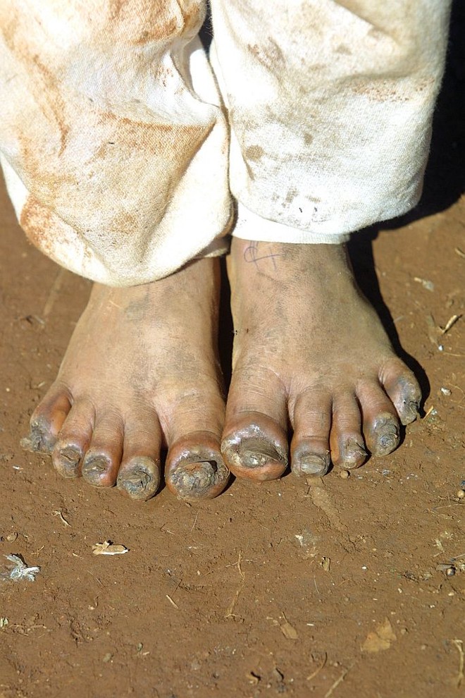 Tratamento médico extraiu os bichos-de-pé de Luís Gabriel, revelado em foto de 2004 | 