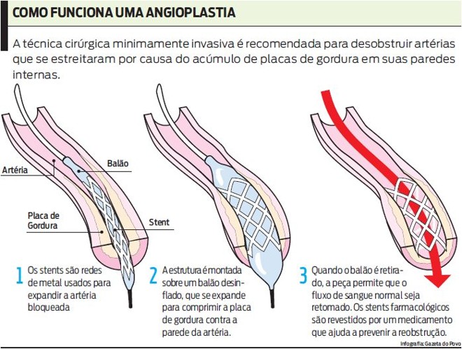 Veja como funciona uma angioplastia | 