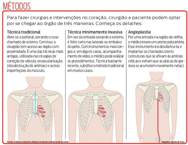 Conheça os métodos usados em cirurgias e intervenções no coração | 