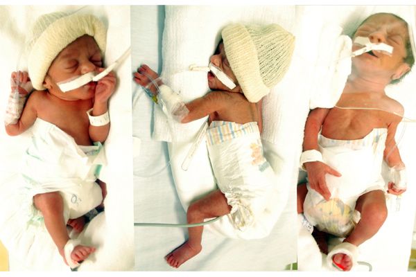 Trigêmeas estão internadas na UTI neonatal | Roger Meireles / Assessoria de Imprensa HMCC