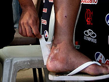 Inflamação não melhorou e Imperador está fora do jogo deste domingo | Reprodução / GloboEsporte.com