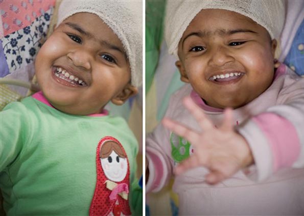 Médicos separam gêmeas siamesas na Austrália | AFP