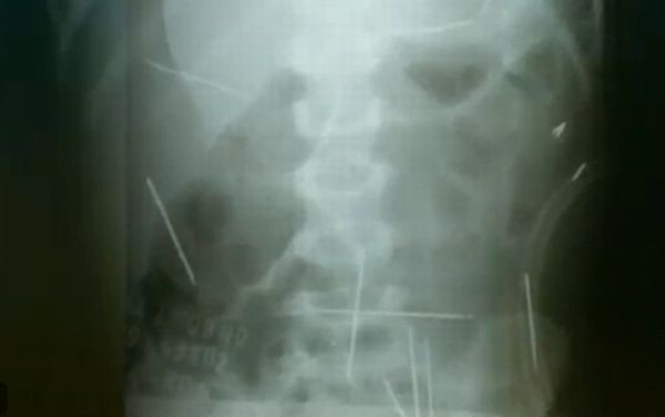 Exame mostra agulhas em menino de 2 anos | Reprodução/TV Globo