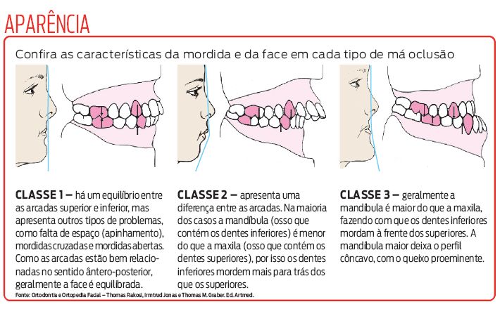 Confira as características da mordida e da face em cada tipo de má oclusão |