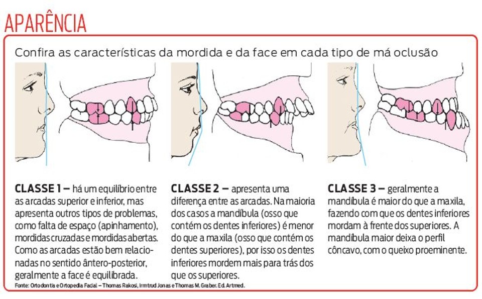 Má oclusão dentária conheça os tipos e como tratar! Clinica OralDents