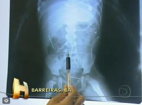 Médicos contaram cerca de 50 agulhas no corpo da criança, que está em estado grave | Reprodução / TV Globo