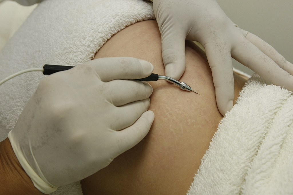 A técnica de subcisão com microagulhas é uma das mais recentes. No centro de estética Lady & Lord, a sessão custa R$ 120 | Marcelo Elias/ Gazeta do Povo