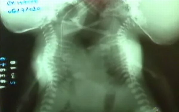 Adolescente de 14 anos dá à luz gêmeas siamesas | Reprodução/TV Morena