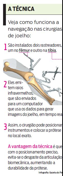 Veja como funciona a navegação nas cirurgias de joelho |