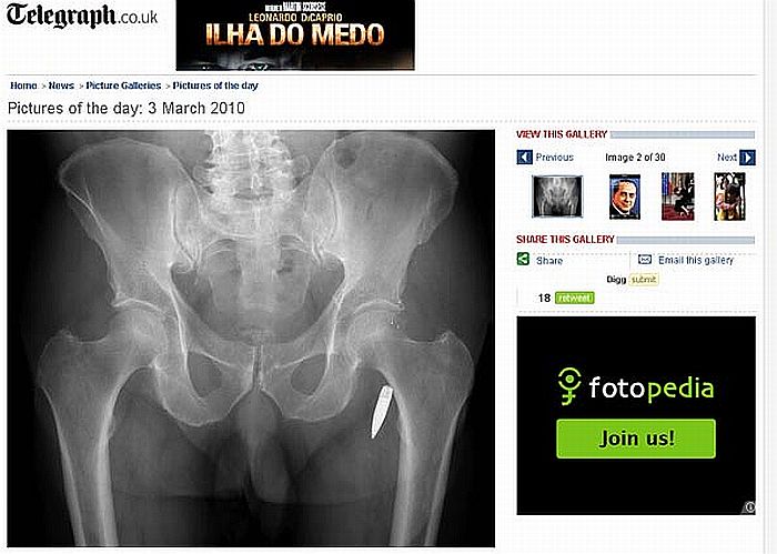 Raio-X mostrou que Fred Gough tinha uma bala alojada na perna | Reprodução/Daily Telegraph