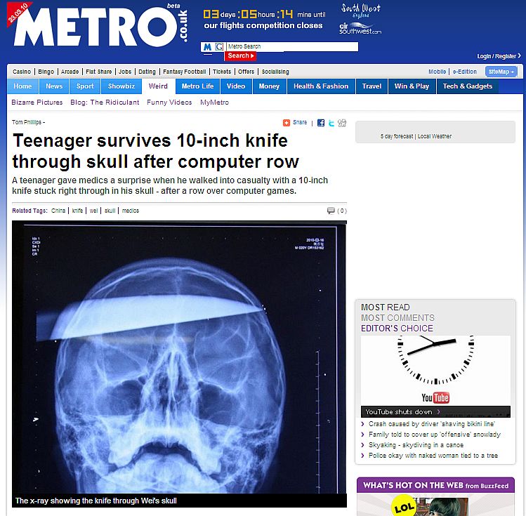 Xiao Wei chegou consciente ao hospital apesar da lâmina de 25 centímetos da faca ter atravessado sua cabeça | Reprodução/ metro.co.uk