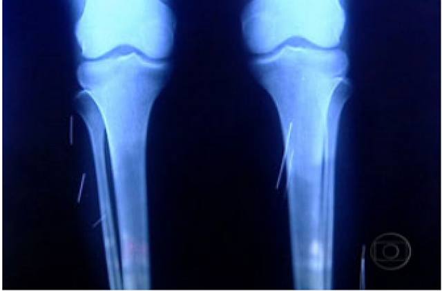 Raio X mostra agulhas no corpo da jovem, que tem problemas mentais e dizia sentir dores | Reprodução / TV Globo