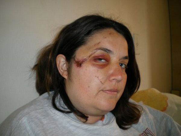 Anna Paola na época do acidente: após três dias inconsciente, as marcas no rosto | Arquivo Pessoal