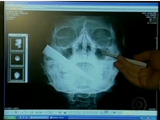 Lâmina de 15 cm ficou dois meses na cabeça do vendedor | Reprodução/TV Globo