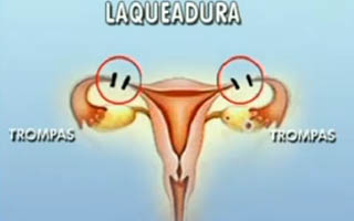 Ilustração de laqueadura | Reprodução/ TV Globo