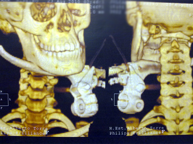 Imagem mostra manete de uma motocicleta atravessando o pescoço da jovem. Médico diz que centímetro salvou a vida da adolescentes | Divulgação / Secretaria Estadual de Saúde