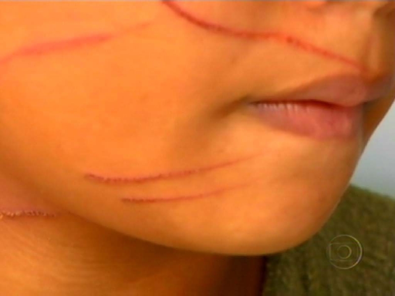 Adolescente de 15 anos foi atacada com uma lâmina de apontador | Reprodução tevê Globo/Ag. O Globo