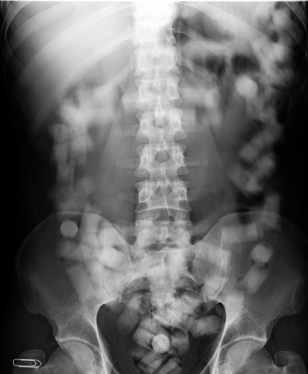 Não havia indícios da droga na bagagem, mas o paraguaio admitiu que havia ingerido cápsulas de cocaína | Divulgação/Polícia Federal