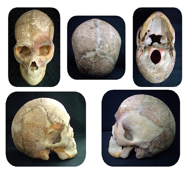 Imagens da reconstrução do crânio de José de Resende Costa. As partes perdidas na exumação foram preenchidas com cera branca | 