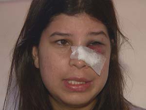 Ana Cláudia teve fratura no nariz após ter sido atacada por colega, segundo ela | Foto: Reprodução/EPTV