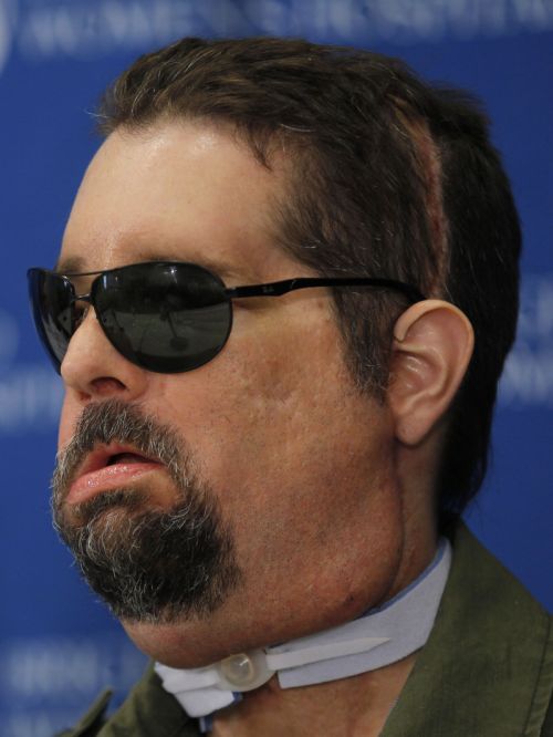 Dallas Wiens sofreu o primeiro transplante de rosto dos EUA | Brian Snyder/Reuters