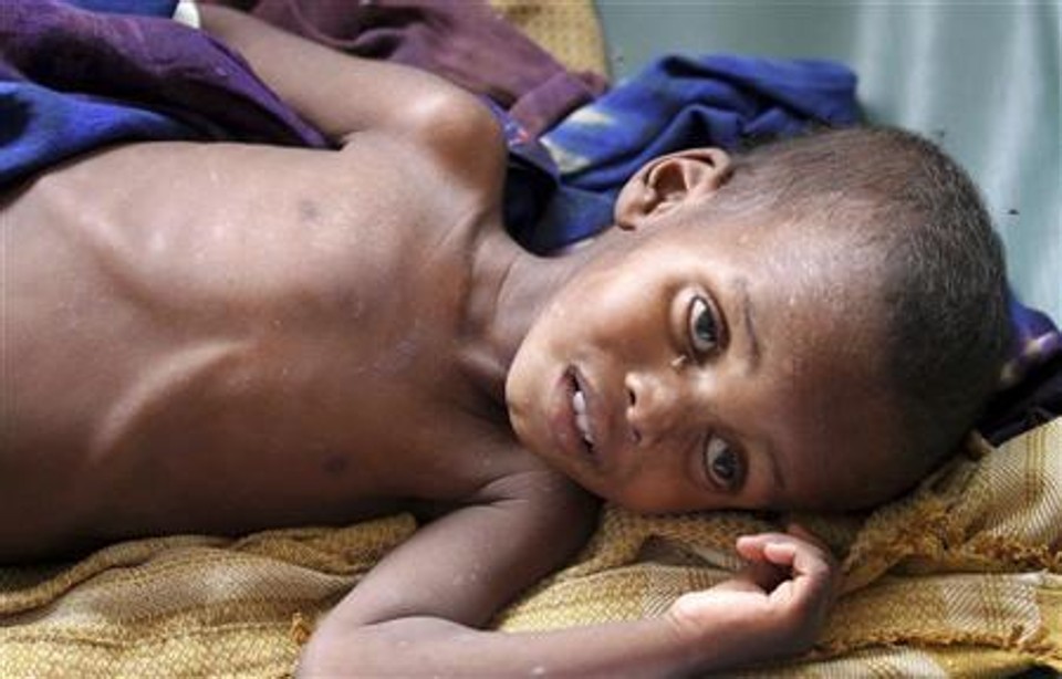 Criança subnutrida descansa no setor pediátrico do hospital Banadir, na capital somali, Mogadishu. A Organização das Nações Unidas declarou estado de fome em duas regiões no sul da Somália nesta quarta-feira e disse que a condição se espalhará rapidamente a menos que doadores tomem medidas | REUTERS/Feisal Omar