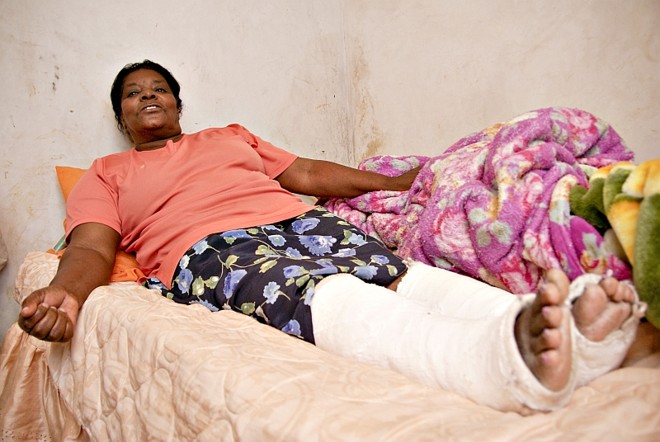 Nadir Jacinto de Souza, que está com as duas pernas engessadas por causa de um acidente em um ônibus na semana passada, diz que não não recebeu nenhum auxílio | 