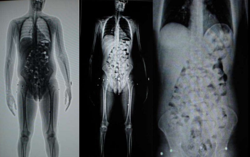 Polícia estima que o homem tenha ingerido pelo menos 60 cápsulas de cocaína | Divulgação/Polícia Federal