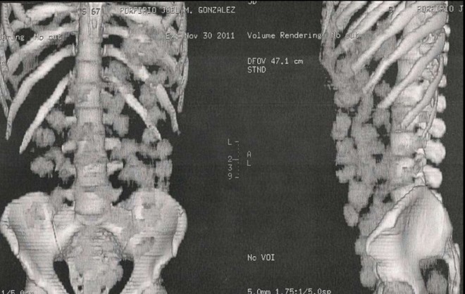 Em outro ângulo, a distribuição das drogas dentro do corpo do homem |