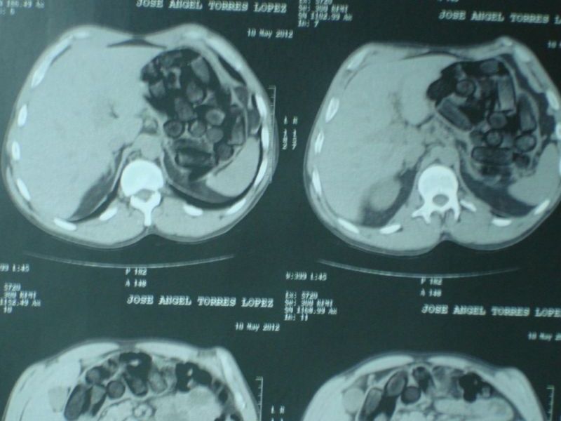 O entorpecente, cerca de 500 gramas, foi descoberto com a ajuda do body scanner aparelho de escaneamento que identifica objetos dentro ou presos junto ao corpo | Polícia Federal/Divulgação