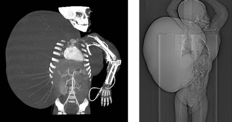 Raio x mostra o tumor de 15 quilos | AFP PHOTO/Mexican Institute of Social Security Press Departament