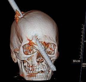 Operário chegou consciente ao hospital; médicos acreditam em recuperação total | Reprodução