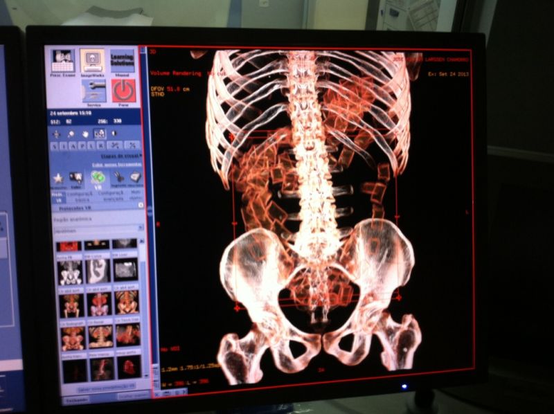 Jovem paraguaio de 19 anos é preso em Foz do iguaçu após engolir cem cápsulas de cocaína para transportá-las até a Espanha | Polícia Federal / Divulgação