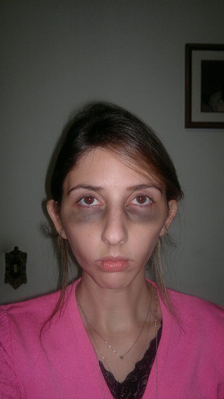 Foto tirada nesta segunda-feira mostra Fernanda com olheiras e mais magra que o normal pelo problema na gengiva | Fernando Amaro/Divulgação