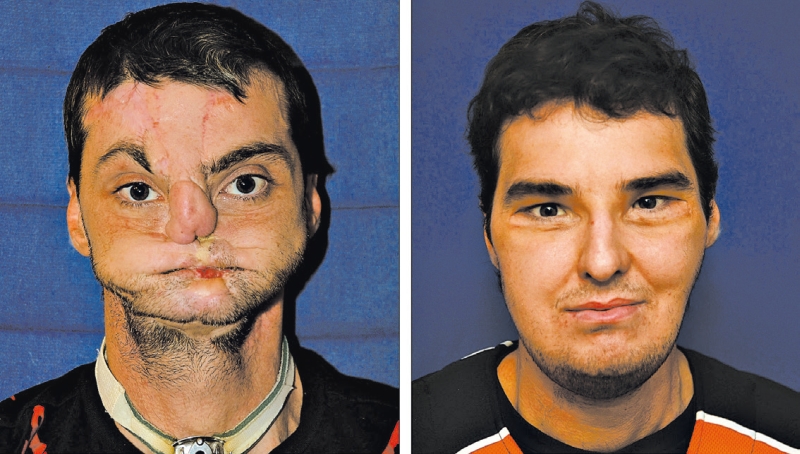 Richard Lee Norris, antes e 16 meses após seu transplante de rosto de 2012. Um tiro de escopeta o havia desfigurado | The Lancet