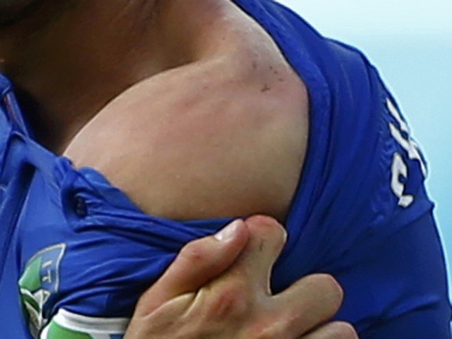 Chiellini mostra marca dos dentes de Suárez em seu ombro esquerdo | 