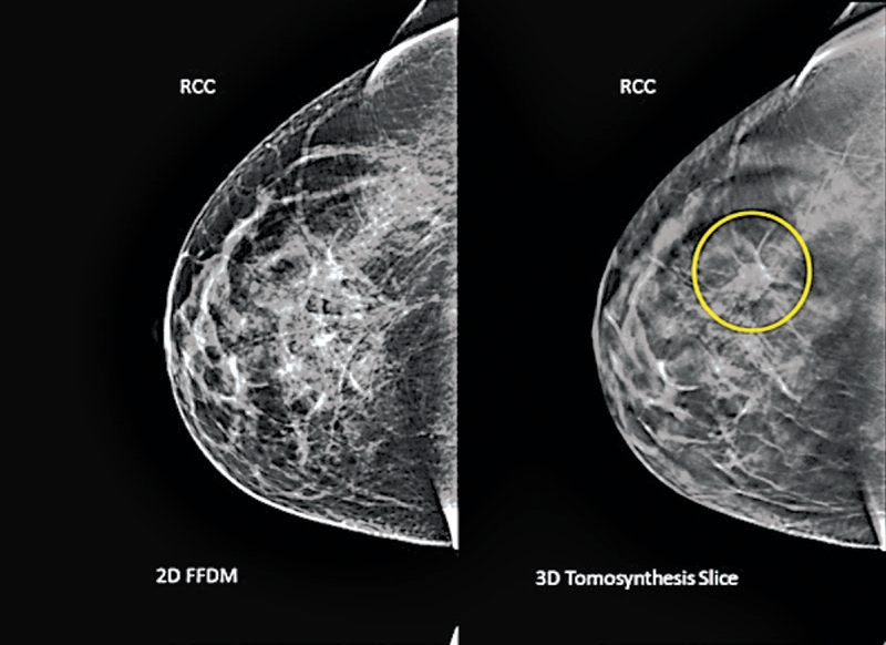 Uma imagem de uma mamografia comum, à esquerda, e uma imagem da tomossíntese com um tumor | hologic