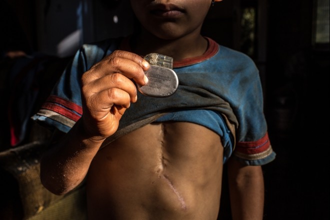 O menino Reginaldo já trocou duas vezes de marca-passo | 