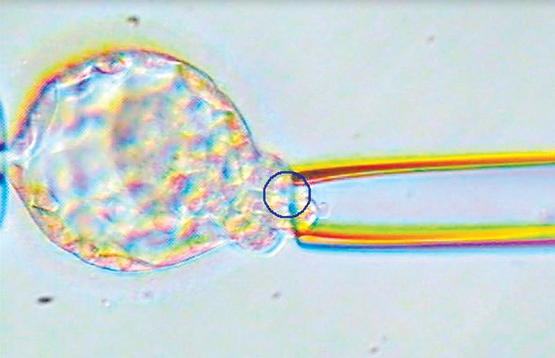 Um exame contra anomalias dá aos médicos a certeza de implantar somente um embrião no útero. Removendo células embrionárias para o exame | Clínica Reproductive Medicine Associates de Nova Jersey